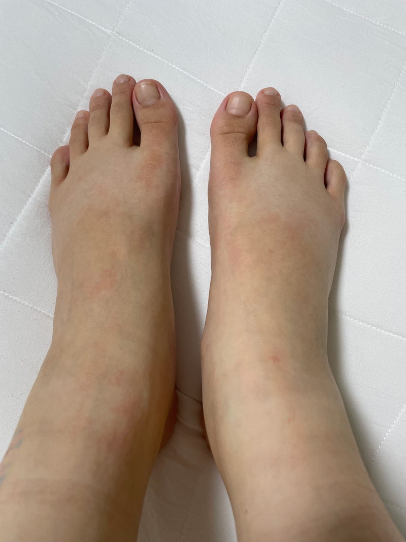 대구신장내과 김현철신장내과의원 신증후군 내원후기