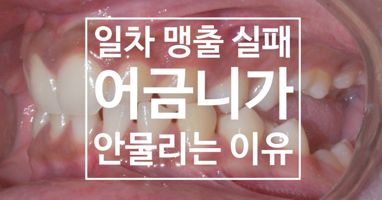  일차맹출실패, Primary Failure of Eruption(PFE) – “치아가 안 올라오는 진짜 이유”를 아시나요?, 어금니 맹출장애, 양평맹출지연
