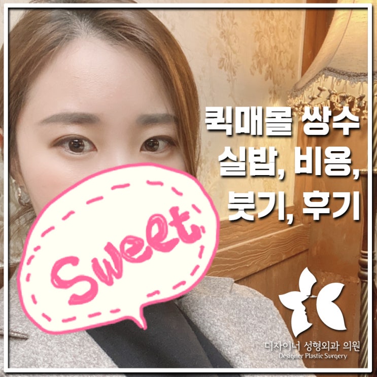  압구정 퀵매몰 쌍수 실밥, 비용, 붓기에 대한 내용을 후기로 확인