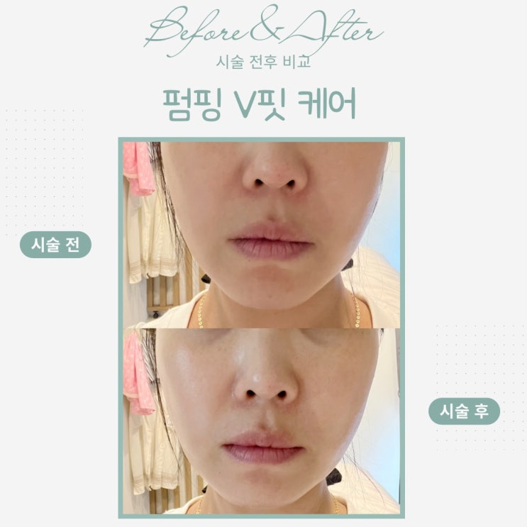  부산동래피부관리- 에어젯 리쥬란윤곽리프팅