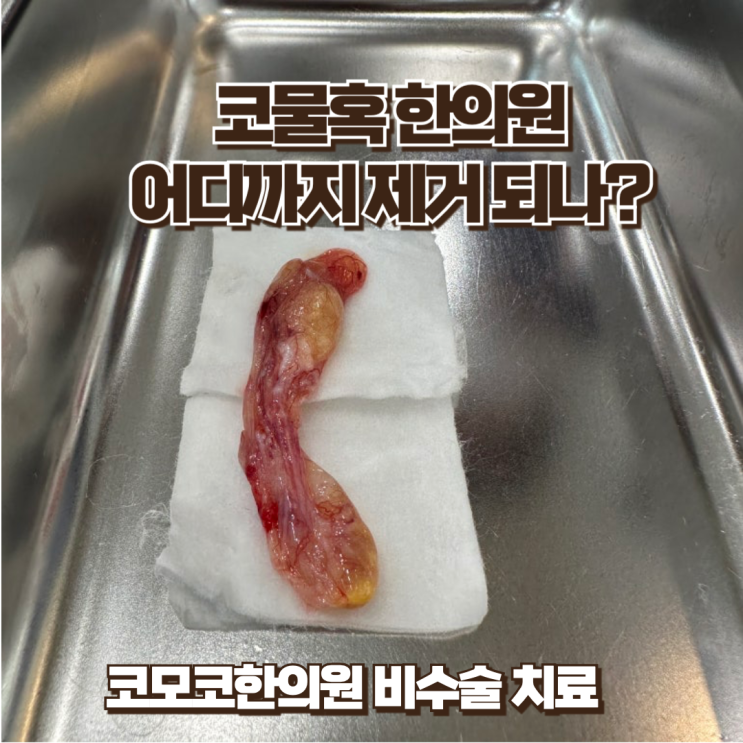  코 안에 혹, 코물혹 한의원에서 제거 가능할까?