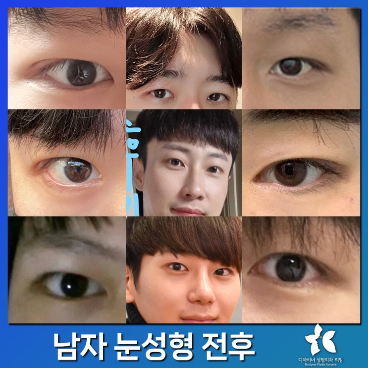  남자눈성형 전후, 실제 변화와 성공적인 수술을 위한 정보