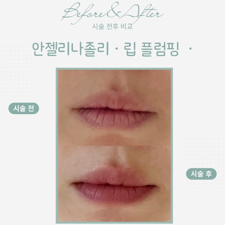  부산동래피부관리 나이 들수록 작아지는 입술? ‘에어젯 리세먼 립 플럼핑’으로