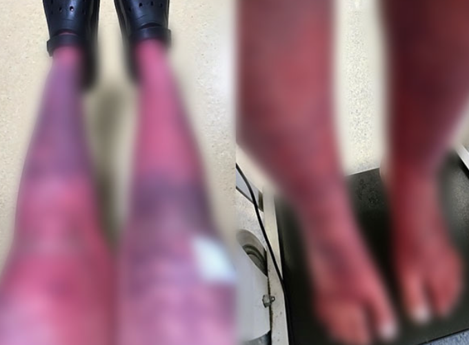  “타는 듯한 고통” 무시한 결과…英 여성, 출산 후 드러난 희귀질환의 진실