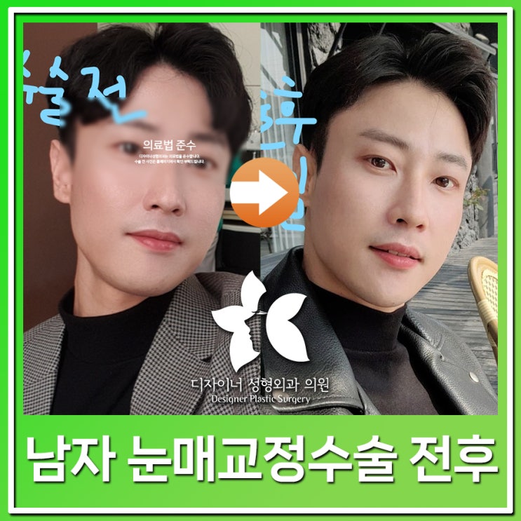  남자눈매교정수술 전후 변화와 실제 후기 정리