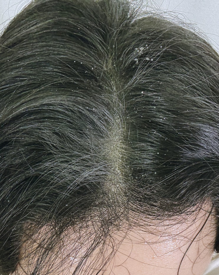  머리 비듬 없애는법? 두피 마사지도 가능한 포뷰트 비듬브러쉬 추천