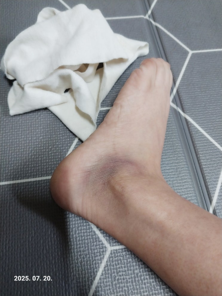  수술 안 한 발목인대파열 관리ㅣ동여맨 고무줄 복숭아뼈 위쪽 흉터