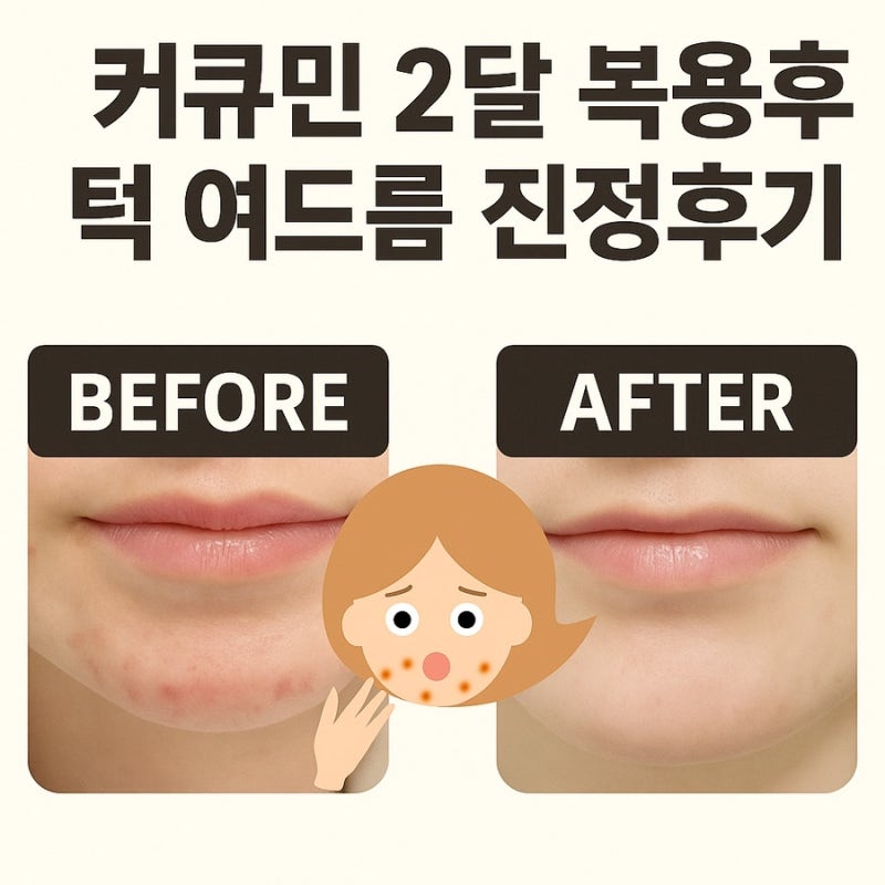 내돈내산 커큐민 영양제 후기｜턱여드름 탈출기 (+피부템 추천)