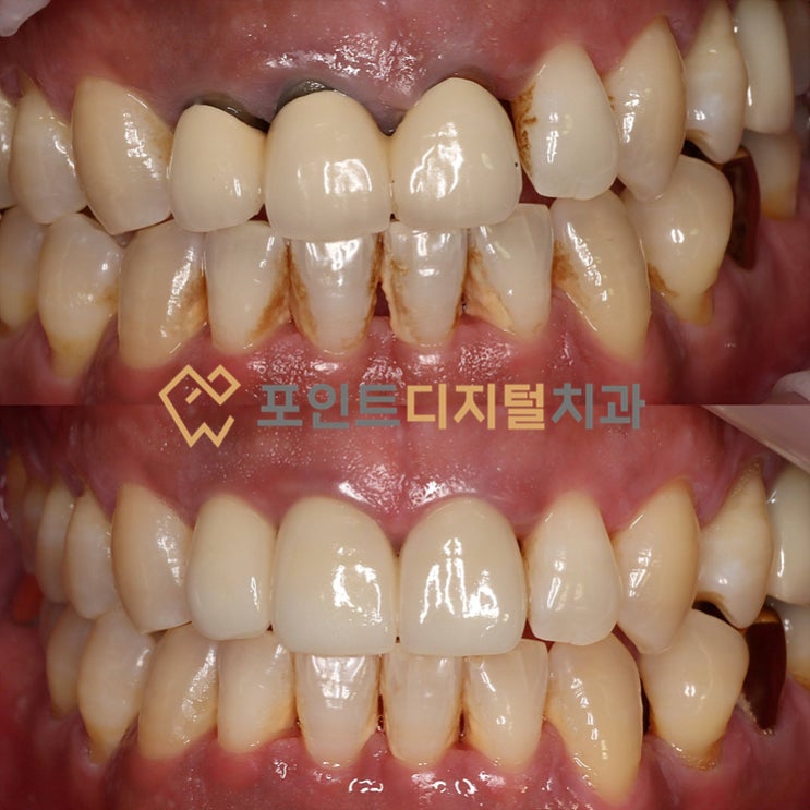  [탕정치과]  심미보철(앞니를 예쁘게) / 천안 아산