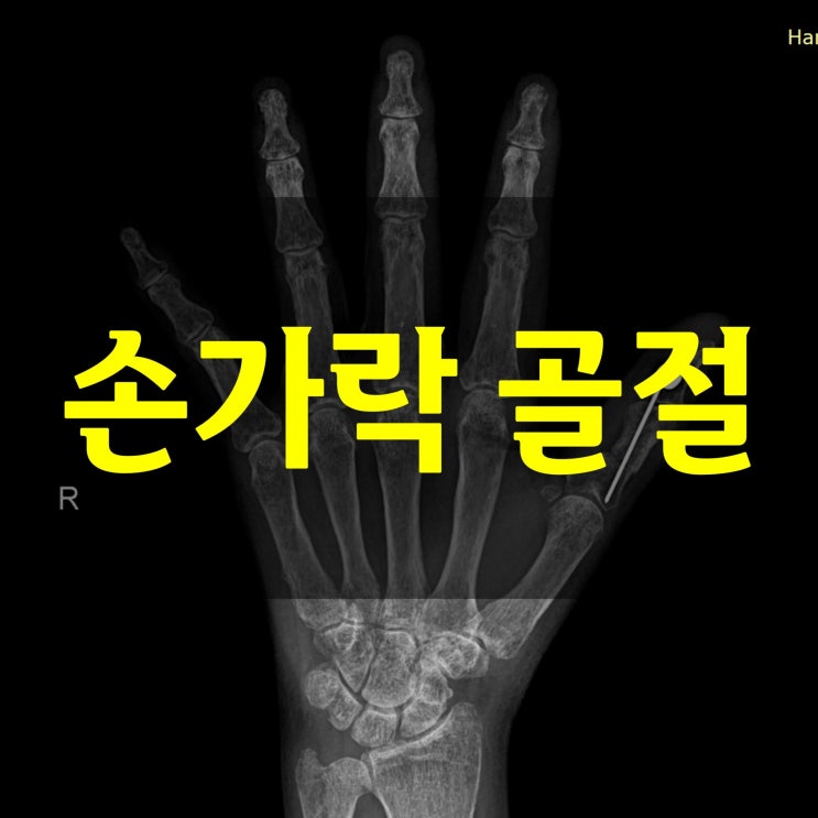  손가락 골절 회복기간 : 운동선수의 복귀 시간을 조사한 연구에서는 OO일 이었습니다.