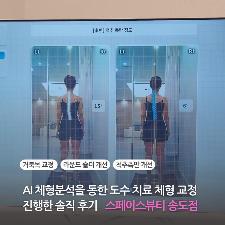  스페이스뷰티 송도에서 AI 체형분석을 통한 도수치료 체형교정 솔직 후기 거북목 라운드숄더 척추측만 개선