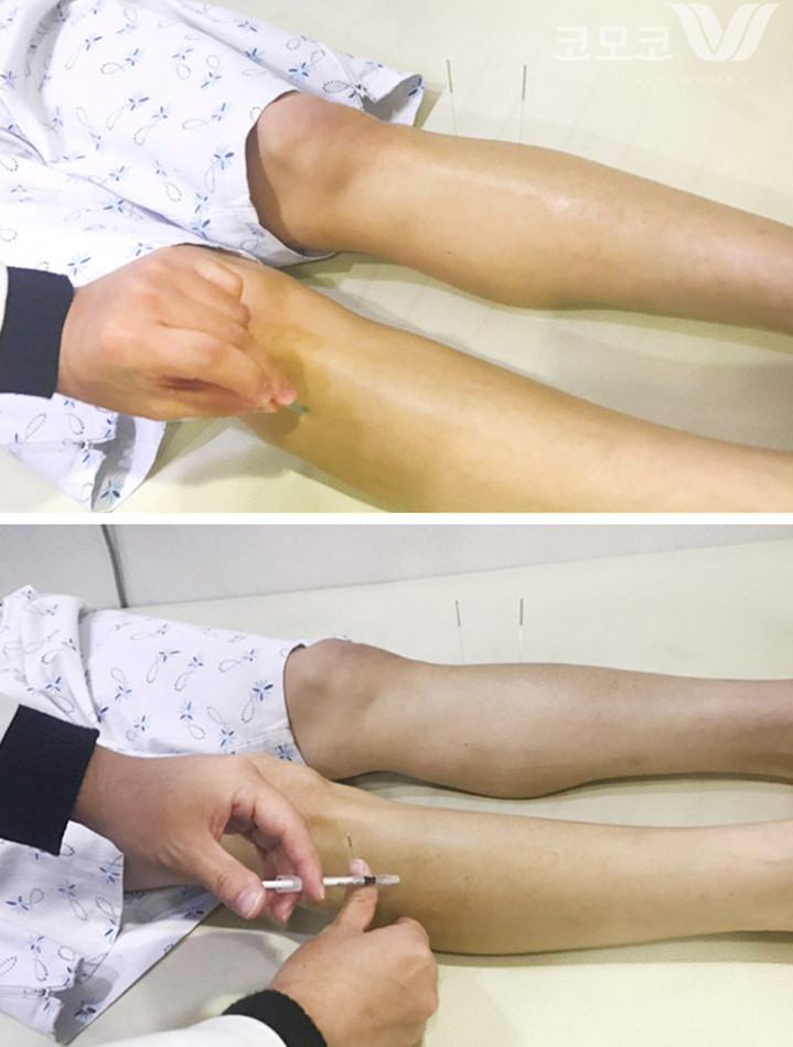  하지불안증후군의 원인, 증상, 한방 치료에 대해 알아봐요