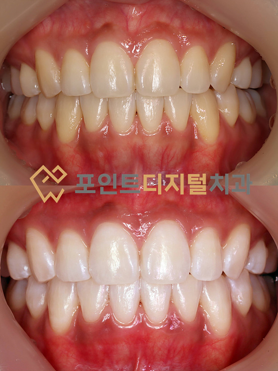  [탕정치과]  오스템 뷰티스 치아미백 케이스 / 천안 아산 불당 배방