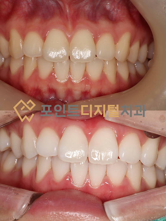  [탕정치과]  오스템 뷰티스 치아미백 원데이와 미백폭발 비교 / 천안 아산 불당 배방