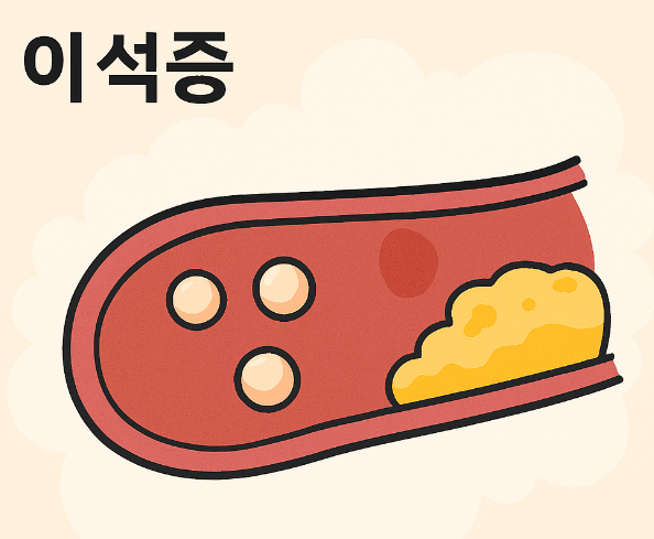  이석증 뜻 , 증상 , 원인 , 치료법 알아봐요