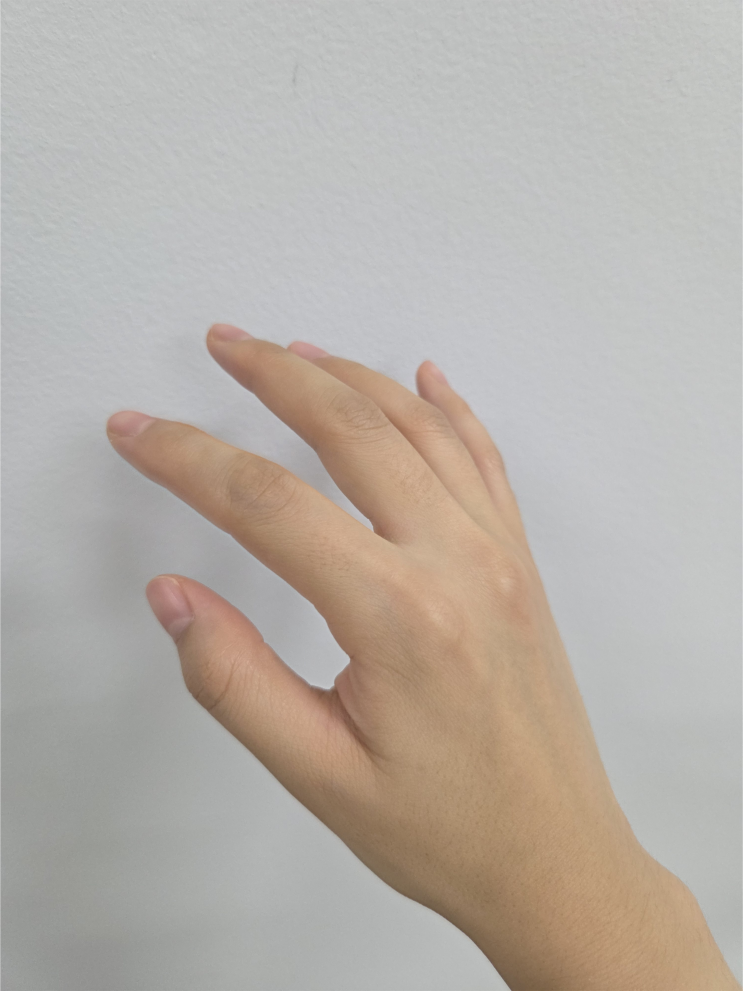  손가락 마디 염증 통증, 가볍게 넘겼다가 결국 관절염까지…