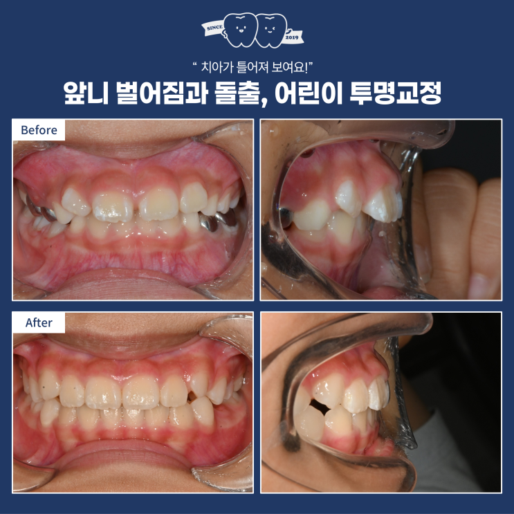  어린이 돌출과 치아 틀어짐 투명교정(인비절라인 퍼스트), 효과적으로 어린이 부정교합 해결하기