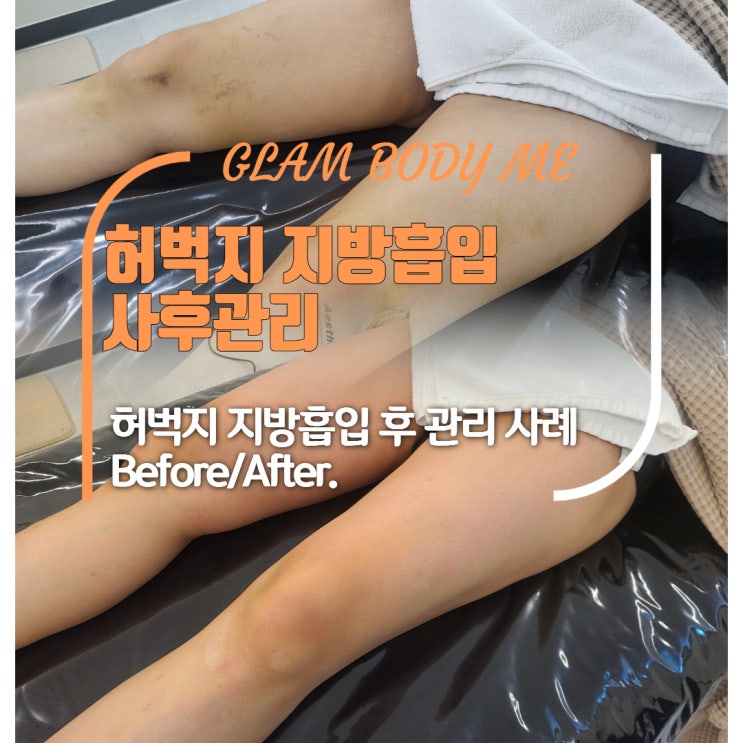  허벅지 지방흡입 사후관리 전.후 사례 공개! (2주 차 - 5주 차)