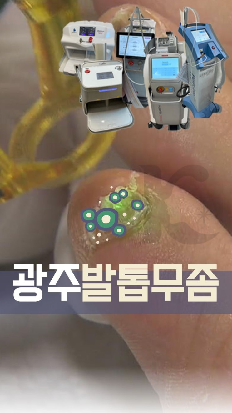  광주발톱무좀 깊어지기 전에 치료하고 싶다면 통증 부담 적은 레이저는