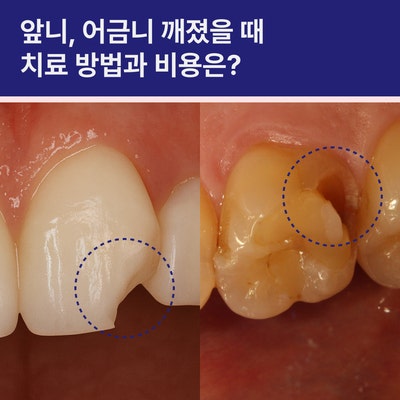 앞니 어금니 이빨깨짐 치료 방법과 비용은?