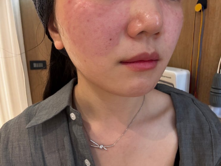  역삼동피부과 리쥬란 피부물광주사 pn리빌더 시술후기(전후, 가격)