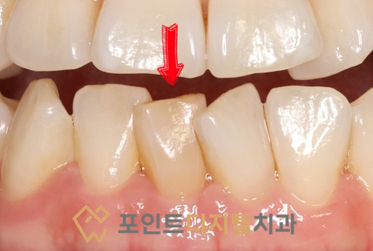  [탕정치과]  실활치 미백(Walking Bleaching) / 천안 아산 불당 배방