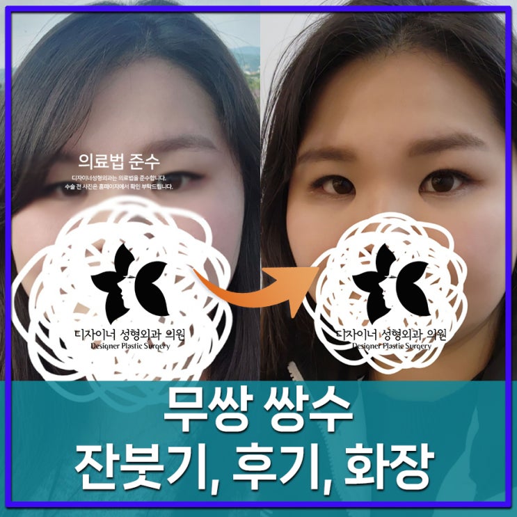  무쌍 쌍수의 잔붓기 시기, 후기 통해 화장 가능한 날짜 확인