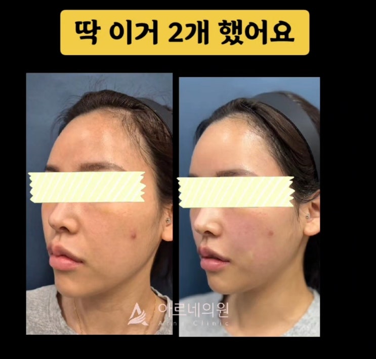  신논현 레디어스 팔자주름 시술 후기 · 효과까지 정리 아르네의원