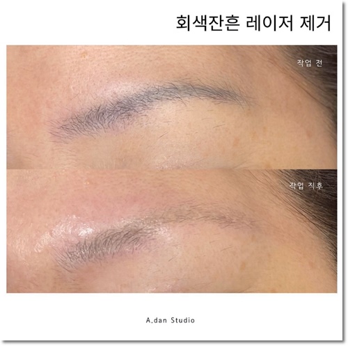  안양눈썹문신제거 잘하는곳 '아단뷰티'