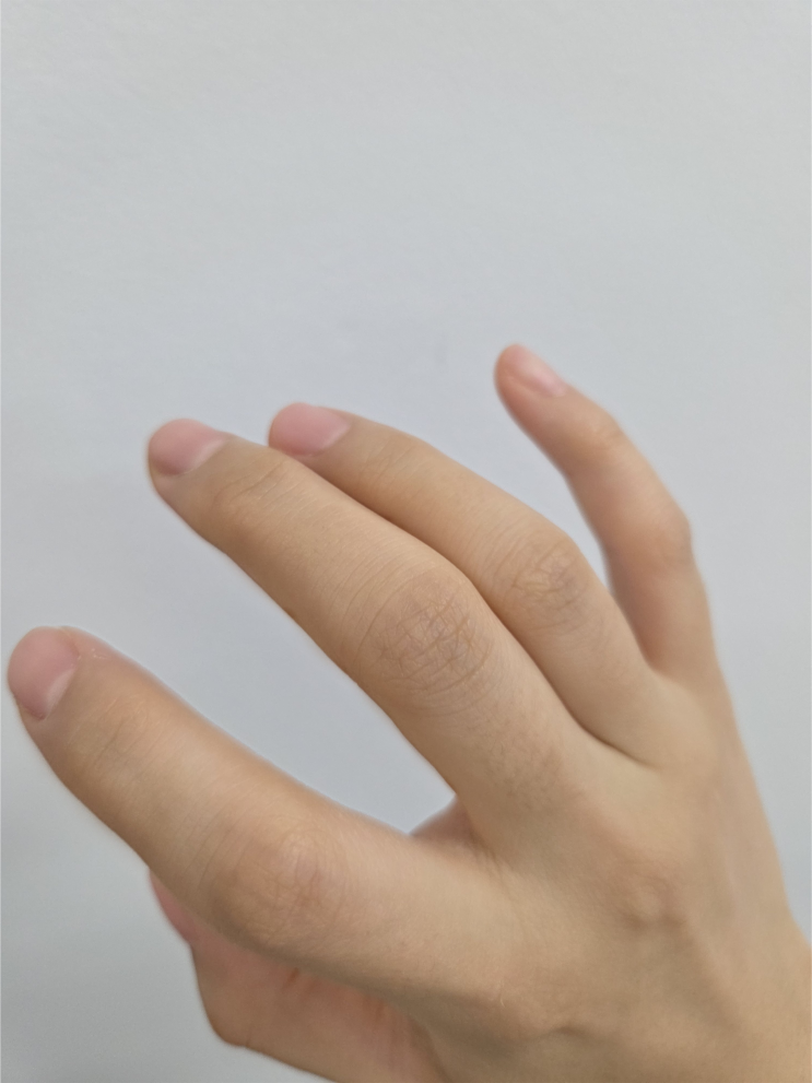  손가락 마디 부음 증상 원인과 해결방법