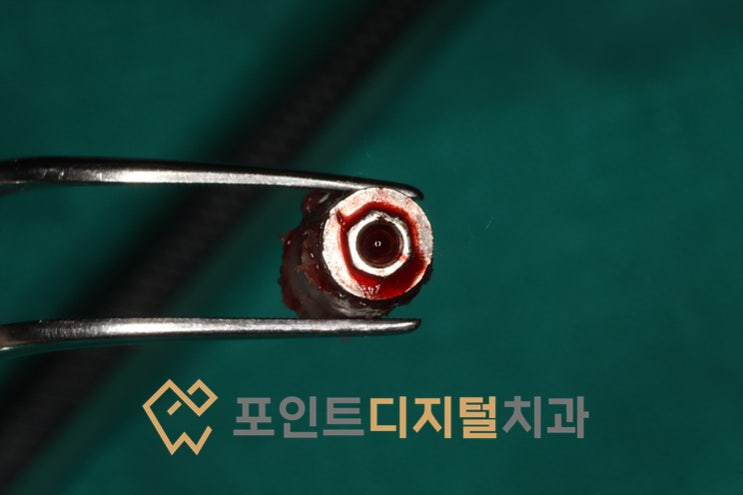  [탕정치과]  타치과 임플란트 제거 + iGBR(급속골이식) + PDRN(연어주사) + 디지털 가이드 임플란트 / 천안 아산