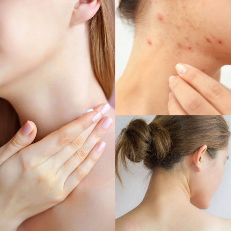  뒷목여드름 원인부터 염증성 여드름 흔적 관리까지