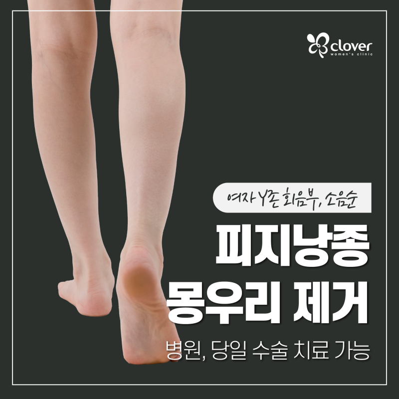 여자 Y존 회음부, 소음순 피지낭종 몽우리 제거 병원, 당일 수술 치료 가능