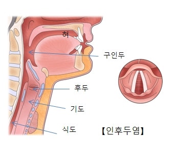 인후염과 후두염의 차이를 알아보자!