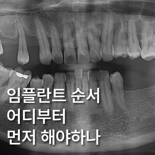  임플란트 순서 어금니부터 앞니부터 어디부터 해야할까요