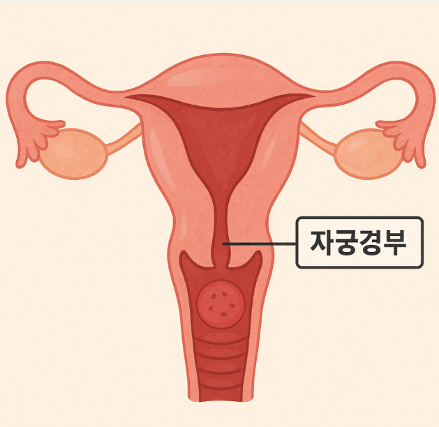 자궁경부가 헐어있다구요? 자궁경부미란 치료(소작술, 고주파)에 대해 알려드려요~