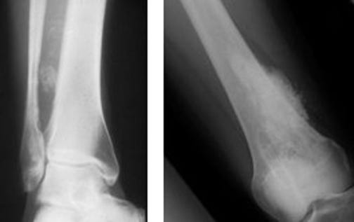 이소성 골화증(Heterotopic Ossification) 과 후종인대 골화증(Ossification of posterior longitudinal ligament)