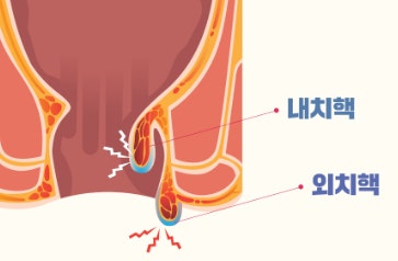  가정용좌욕기 집에서 간편 관리 후기