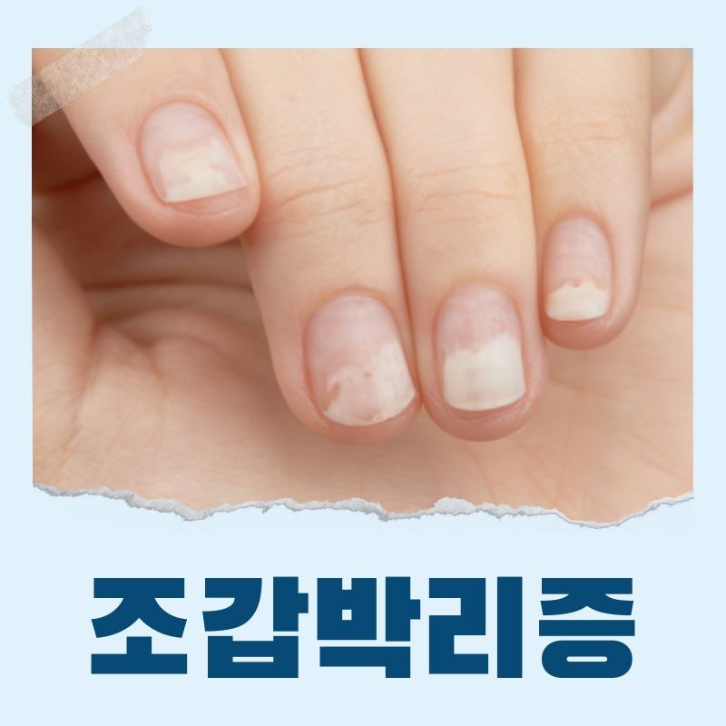 손톱 조갑박리증 연고 치료 및 병원 필요성