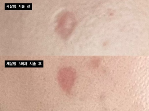  [흉터 치료] 교대역 한의원 새살침 내돈내산 후기(한의원 3곳 전격 비교)