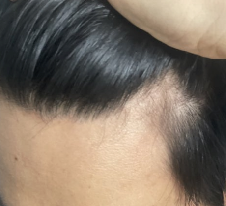  남자 정수리 탈모 치료 후 영양제 관리 후기