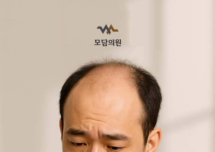 대전 자연스러운 모발이식 모담의원, 모발이식 가격은?