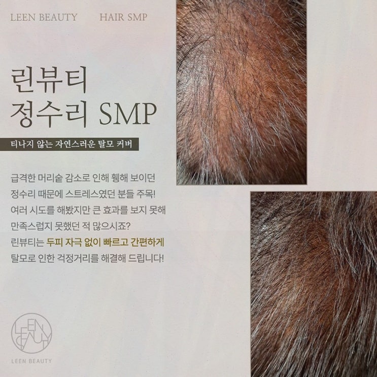  삐땅기 린뷰티, 유륜미백으로 자신감 회복하기