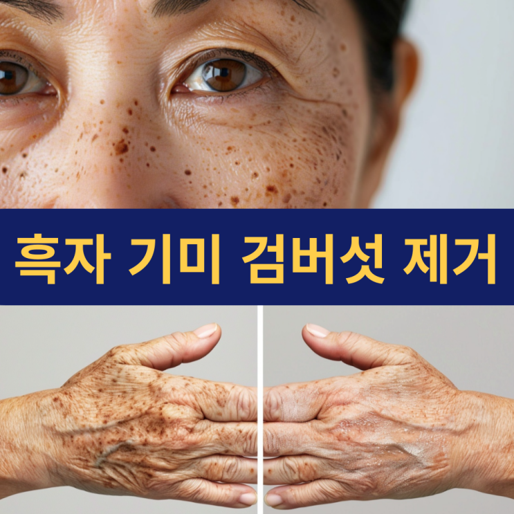  흑자 제거 | 지루각화증 검버섯 제거 | 원인부터 해결책까지 총정리