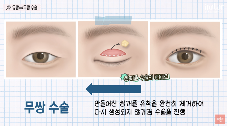무쌍 여자 연예인처럼 수술 가능할까? (<b>조이현</b>, 레드벨벳 슬기)