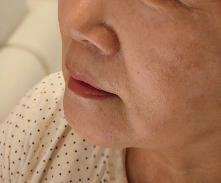  수원 쥬브젠 팔자주름없애기 레알 후기