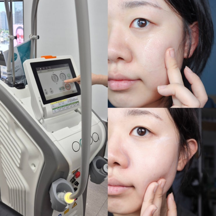  볼살 고민이라면? 온다리프팅과 함께한 신사피부과관리 후기