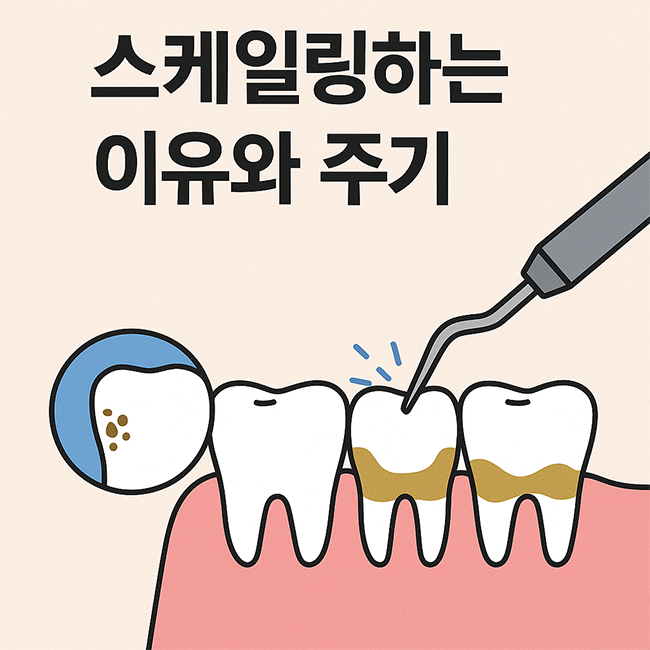  스케일링, 언제부터 해야 하고 얼마나 자주 받아야 할까?