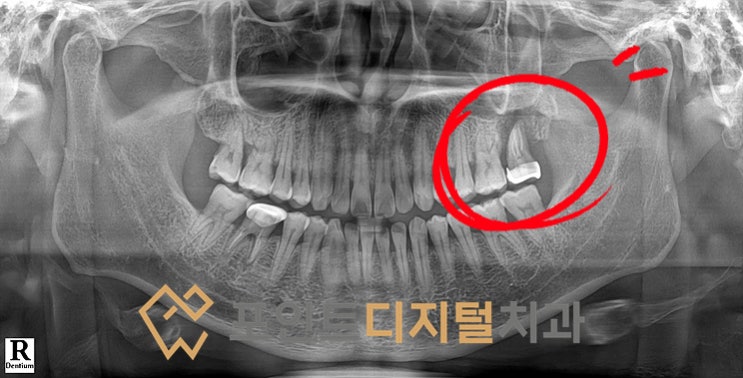  [탕정치과]  임플란트 식립이 불가능해보였던 케이스 : iGBR(급속뼈이식) + PDRN(연어주사) + 디지털 가이드 + 비절개 임플란트 / 천안 아산