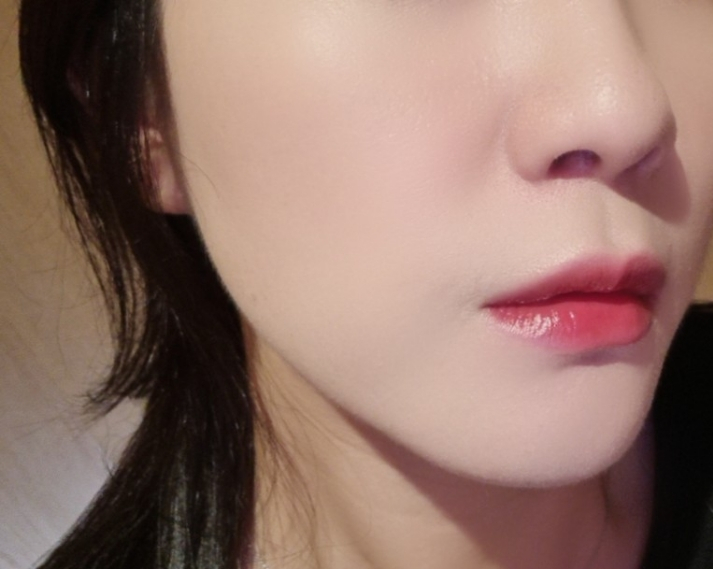  도곡역피부과 튠페이스 쥬베룩볼륨 효과 후기